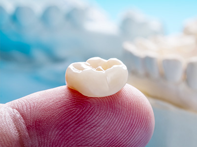 Ceramic Dental Crowns in Oakville ON