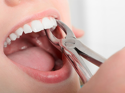 Tooth Extractions in Oakville ON