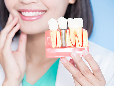 Dental Implants Oakville ON