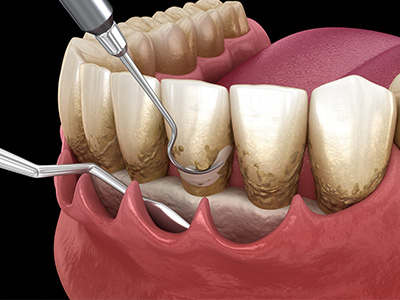 Family Dentist in Oakville ON