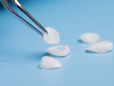 Oakville ON Dental Veneers