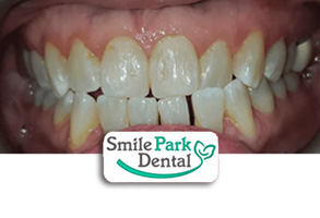 Dental Implants Dentist Oakville ON