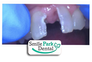 Dental Implants Dentist Oakville ON
