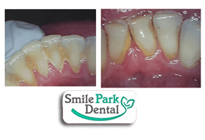 Dental Implants Dentist Oakville ON