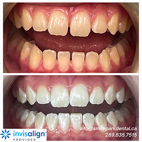 Smile Park Dental | Dental Bridges, Implant Dentistry and Dentures