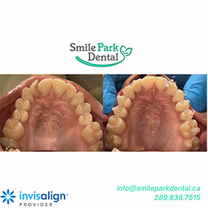 Smile Park Dental | Invisalign®, ZOOM! Whitening and Digital Radiography